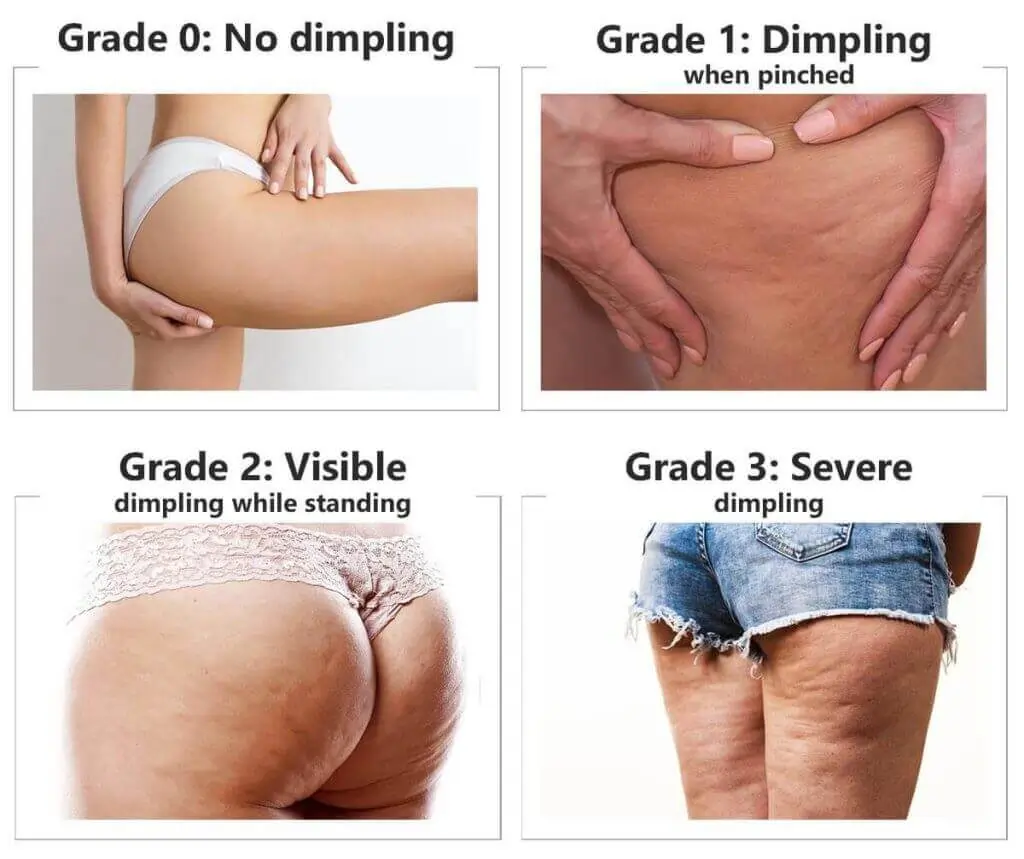 Representation of the stages of cellulite development Eastbourne